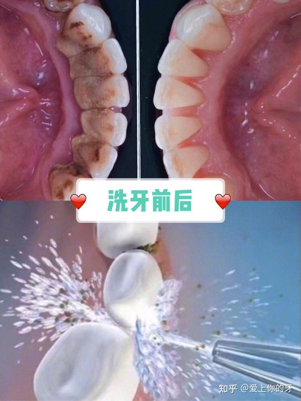 海南洗牙可以用医保吗(洗牙可以用医保吗,报销比例多少)